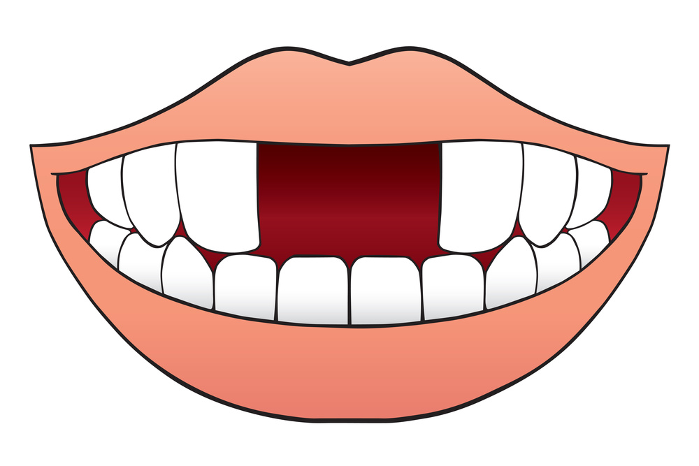 牙齒缺失怎麽辦？怎麽修復？