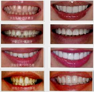 在深圳做牙齒貼面推薦愛康健齒科