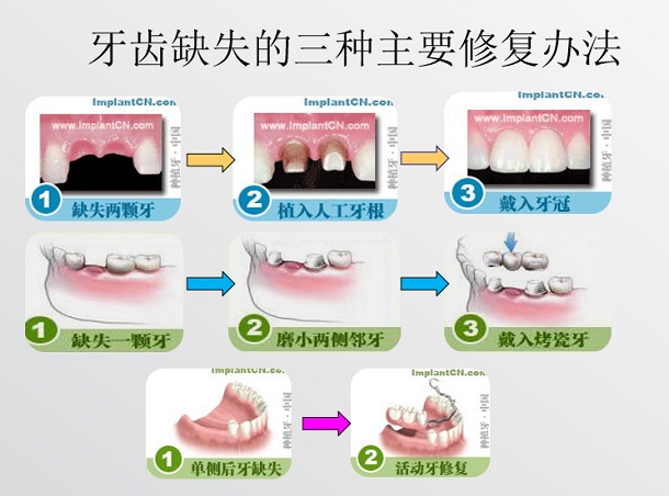 愛康健齒科有做活動義齒嗎