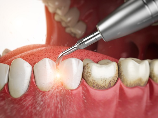 牙結石有什麼危害?深圳愛康健牙結石洗牙價錢