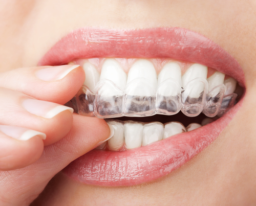 深圳愛康健牙醫解析|牙齒間隙大怎麼矯正比較好
