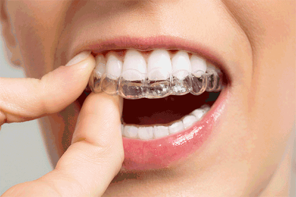 想矯牙又不想要“鐵齒鋼牙”,透明牙套靠譜嗎？