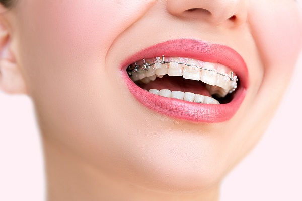 齙牙/凸嘴/露齦笑可以通過箍牙矫牙解決嗎？