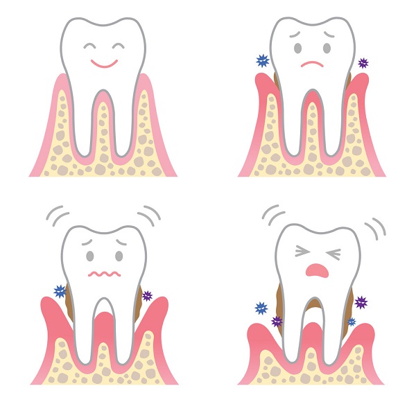 牙周病引起牙齒松動怎麼治療好的辦法