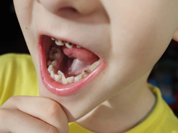 孩子長了「雙排牙」該怎麼辦？