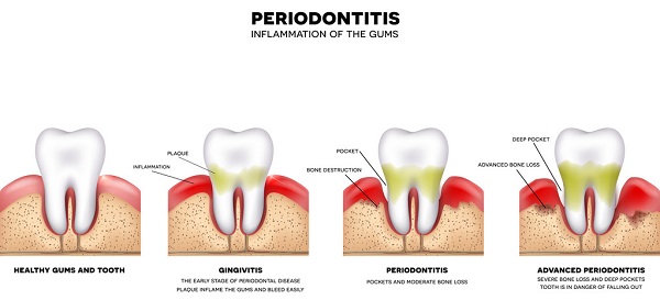 牙周病有哪些危害?牙周炎怎麼治療