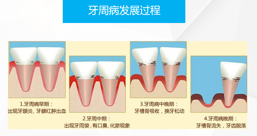 得了牙周病怎麼辦?深圳治療牙周炎要多少錢