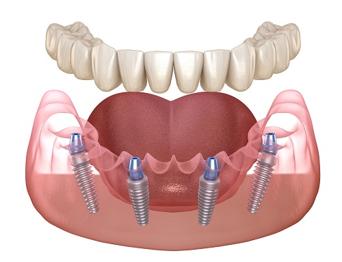 多顆牙缺失怎麼補救?種植牙過程會不會很痛