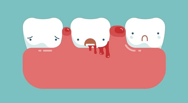 刷牙出血是怎麼回事兒?牙齦出血怎麼辦