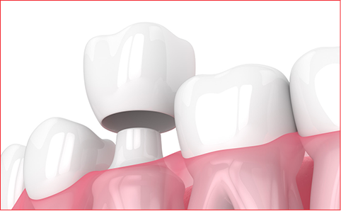 牙齒修復,為什麼很多牙醫都推薦做全瓷牙?