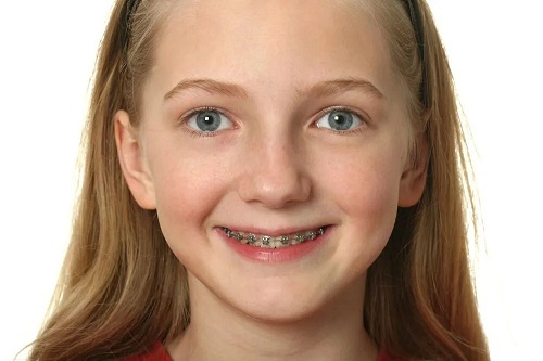 兒童替牙期的牙齒不整齊有哪幾種?深圳箍牙推薦