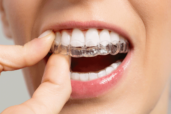 整牙攻略|盤點各種牙齒矯正(箍牙)牙套的優缺點!