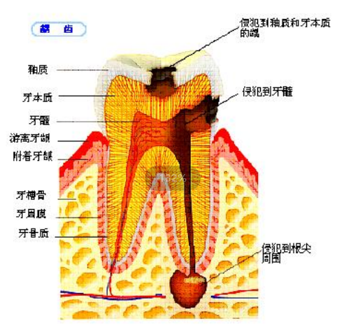 深圳牙科醫院做根管治療價錢是多少?