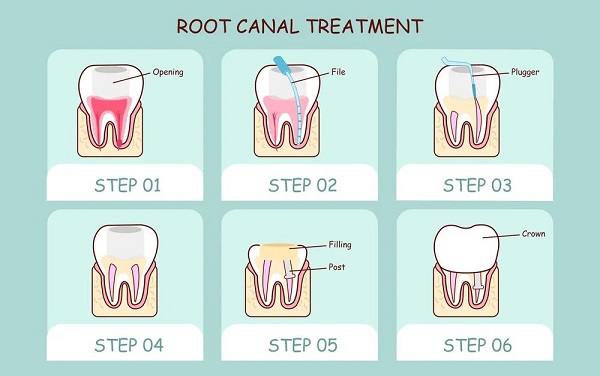 根管治療後牙齒還疼,可能是以下這些原因
