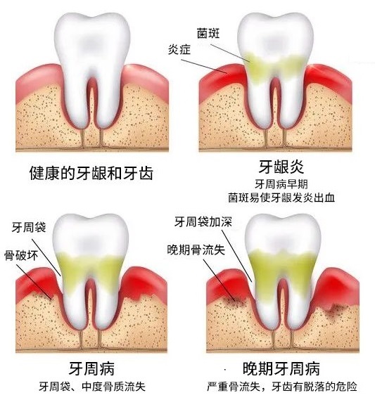 有牙周炎的患者還能做種植牙嗎？