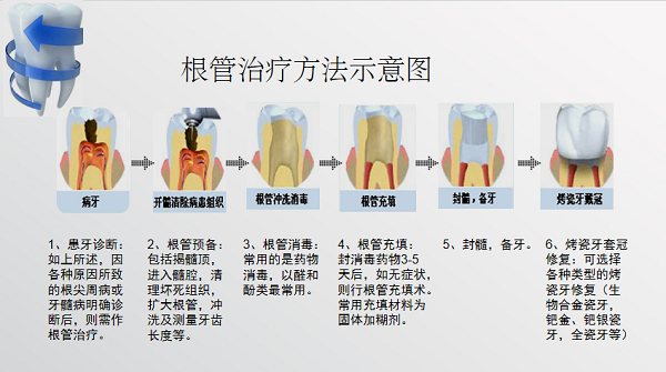 根管治療過程及步驟?深圳愛康健牙科杜牙根怎麼收費