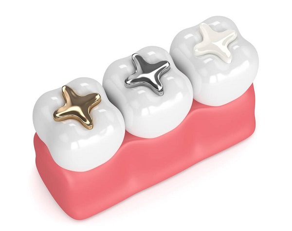 深圳愛康健牙科解析|目前補牙材料這麼多要怎麼選才好?