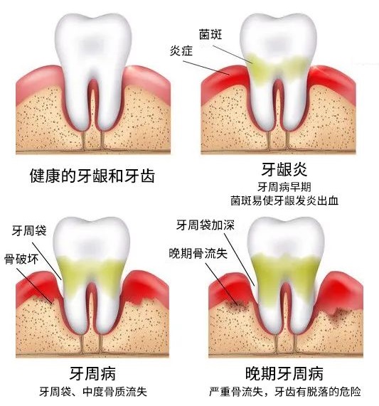 牙周病是成人牙齒缺失的主要原因,也是危害人類健康的牙病
