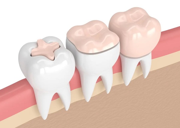 請問哪些牙齒問題可以用嵌體修復進行補牙