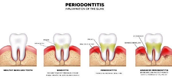 牙周炎的早期癥狀表現有哪些?牙周炎簡單的辨別方法