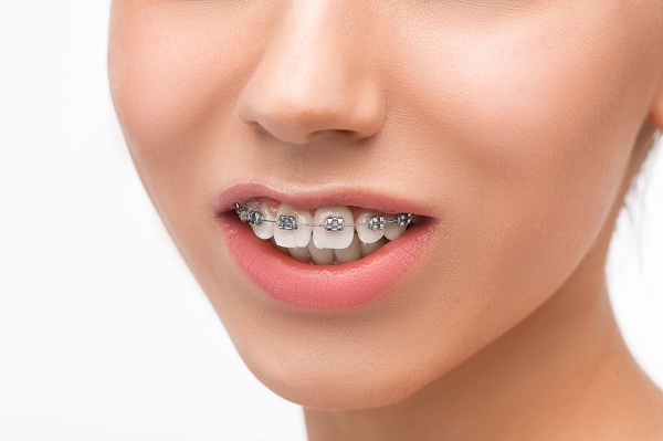 做完牙齒矯正後為什麼會出現牙套臉？