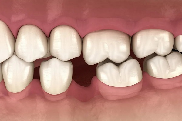 缺牙什麼時候種牙比較好?深圳愛康健牙科植牙幾錢