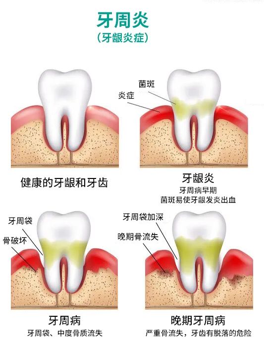 牙周炎是什麼原因引起的?牙周炎發展的4個階段