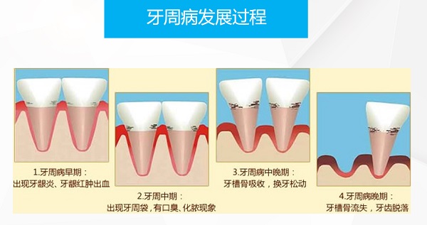 牙周炎有什麼危害?牙周病是怎麼引起的