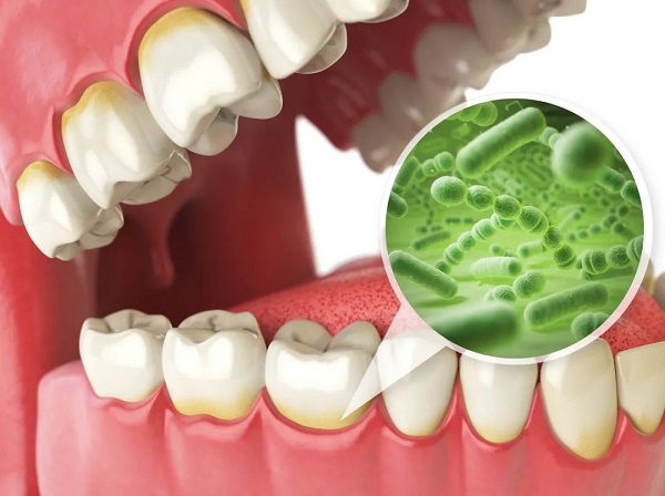 深圳愛康健牙科牙周病治療費用多少?牙周病如何治療