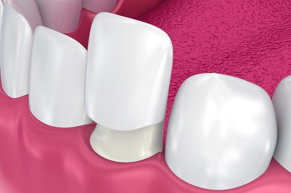 牙齒貼面做了後悔怎麼辦?瓷貼面可以修復牙齒美觀嗎