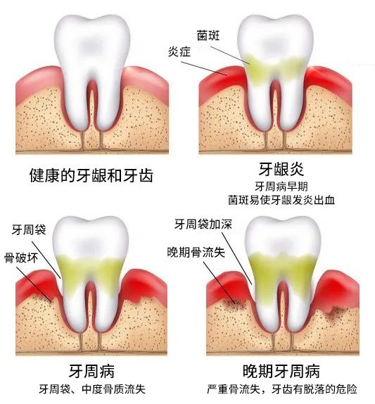有牙周病的患者,還可以做牙齒矯正嗎？