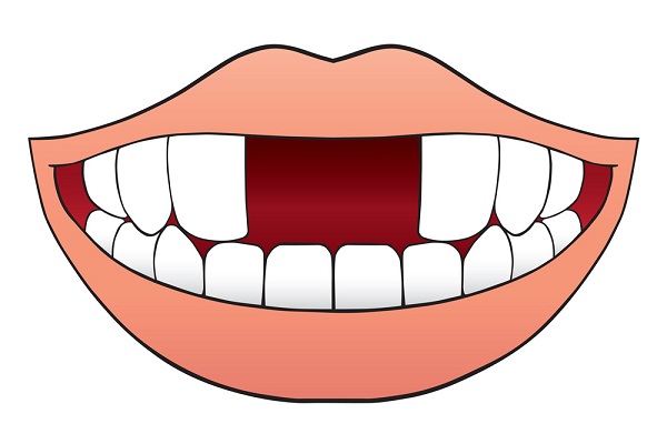 門牙缺失怎麼修復？三種方法來幫您解決