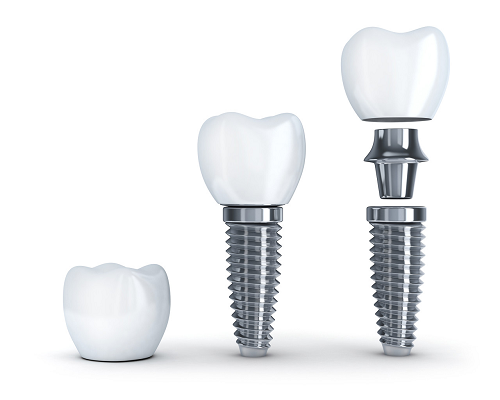 牙齒缺失的修復方法有哪些?牙醫為什麼要推薦做種植牙