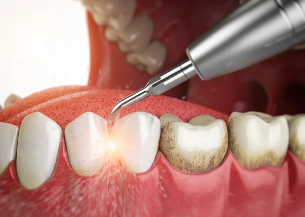 深圳愛康健齒科醫生解析|定期洗牙有什麼好處?