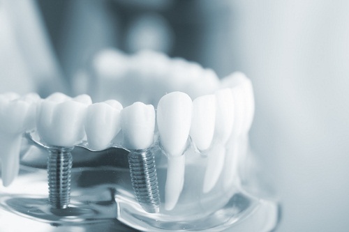 種植牙能用壽命多久？是不是人人都適合做種植牙來修復缺牙
