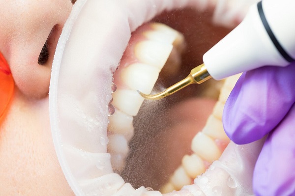 洗牙齒有什麼好處和壞處?深圳愛康健牙科洗牙價格是多少