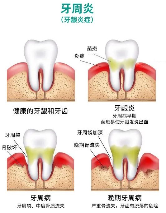得了牙周病该怎么办|牙周病怎麼治療|愛康健牙周病治療能使用香港醫療券