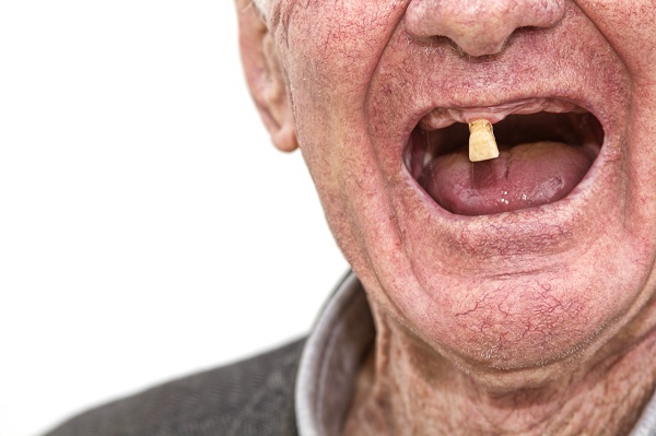 深圳全口種植牙推薦愛康健口腔醫院盧勇輝院長!同時65歲及以上長者植牙可使用香港長者醫療券!