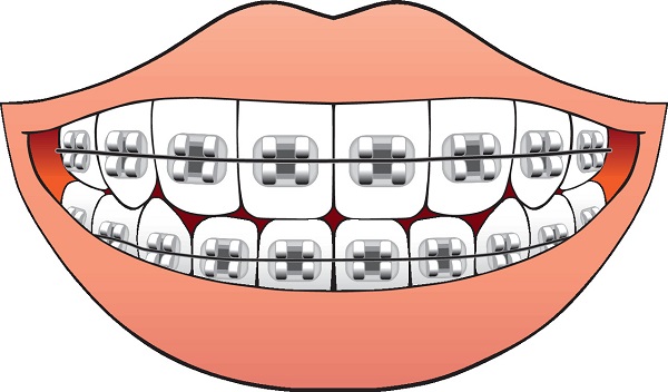 深圳箍牙多少錢