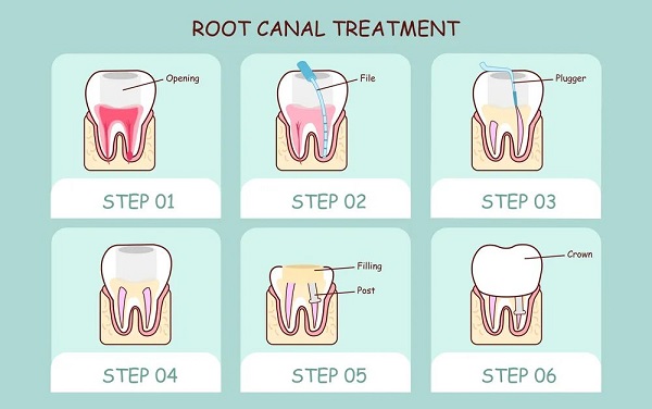 深圳根管治療費用多少