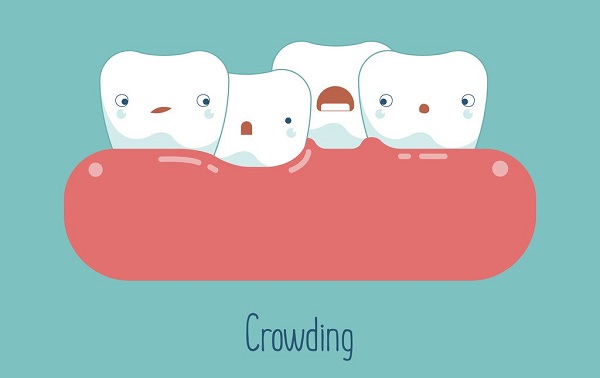 深圳牙齒擁擠矯正多少錢