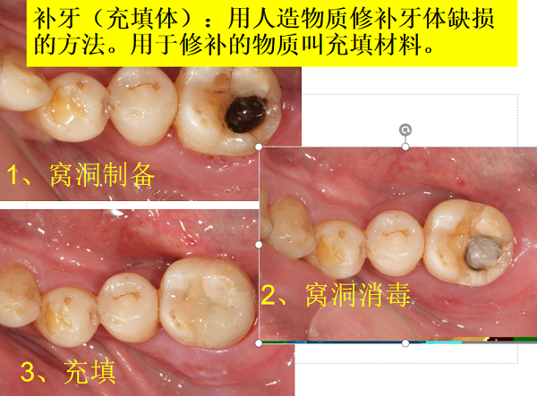 深圳補牙大約多少錢