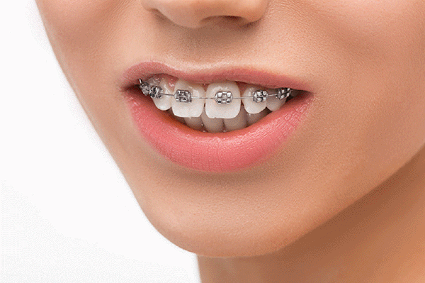 40歲牙齒還能矯正嗎