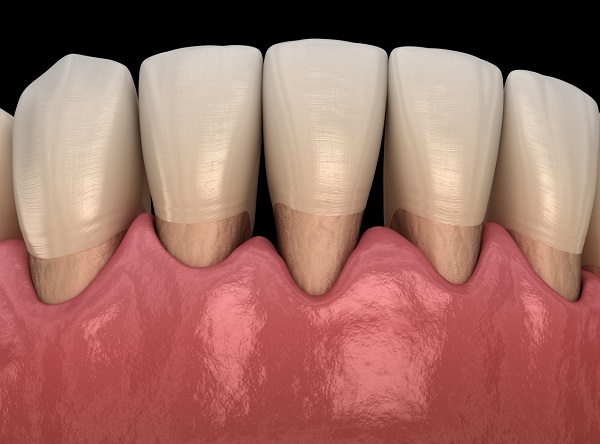 門牙牙縫大怎麼修復