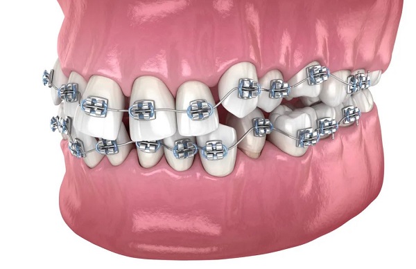 深圳箍牙多少錢