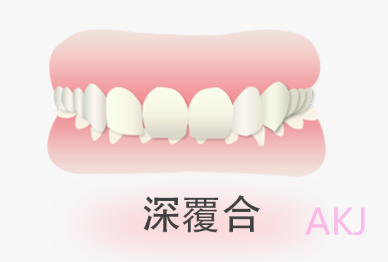 深覆合是否必須矯正