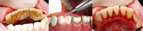 深圳洗牙收費價格表