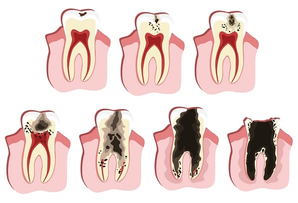 蛀牙初期可以自我修復嗎