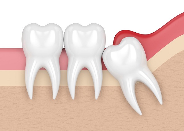 拔大牙多少錢一顆啊