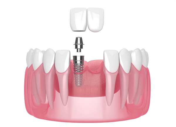 深圳種植門牙要多少錢